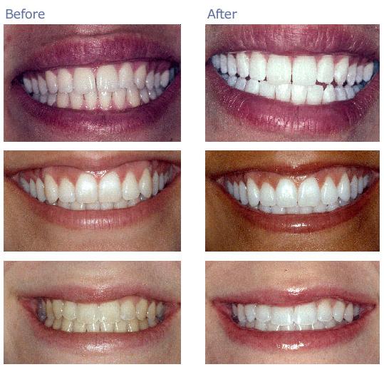 DEARSUGAR NEEDS YOUR HELP: Is Tooth Whitening For Me?